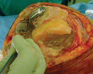 Illustration 21 for Revision of Failed UKA: Your Guide to Successful Treatment