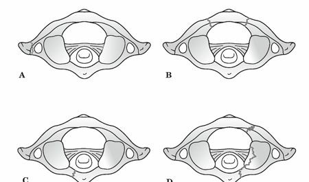 Atlas Fractures: Spot Symptoms & Get Expert Treatment Insights