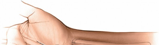 Illustration 76 for Essential Surgical Approaches: Uncover Every Aspect of the Wrist