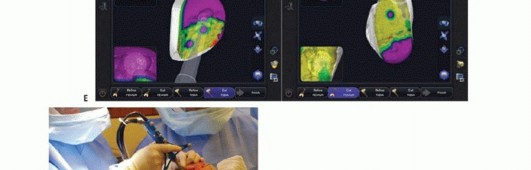 Illustration 23 for Unicondylar Knee Arthroplasty: Is This Your Solution to Knee Pain?