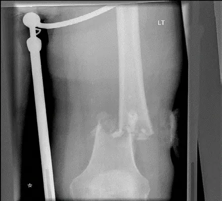 صورة توضيحية لـ الساركوما الغضروفية فهم شامل وخيارات العلاج المتقدمة مع الدكتور محمد هطيف في صنعاء