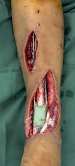 Illustration 32 for Decoding Pilon Fractures: Anterolateral and Medial Fragments Revealed