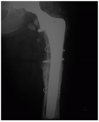 Illustration 6 for Revision THA: Why Extensively Porouscoated Cylindrical Stems Excel