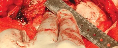 Illustration 11 for Posterolateral Surgical Approaches: Achieve Optimal Hip Replacement