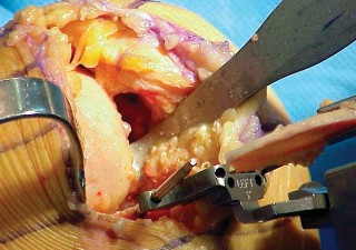 Illustration 36 for Unicompartmental Knee Arthroplasty: Master decisions with this b c figure guide.