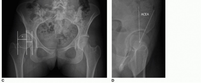Illustration 7 for Periacetabular Osteotomy: Realigning your hip via the superior pubic ramus