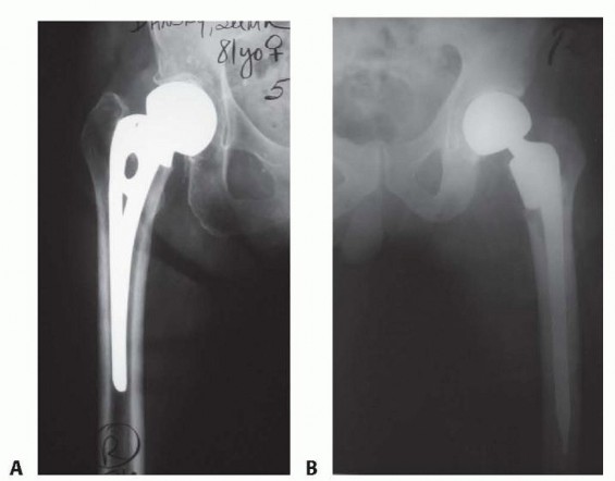 Illustration of hemiarthroplasty of the hip - Dr. Mohammed Hutaif