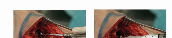 صورة توضيحية لـ تجنب الجراحة الكبرى: علاج أورام العظام بالنيتروجين السائل بتقنية الصب المباشر