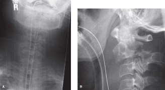 Illustration of adjacent segment degeneration - Dr. Mohammed Hutaif