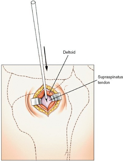 Illustration 5 for Step-by-Step Guide: Minimally Invasive Approach to the Proximal Humerus