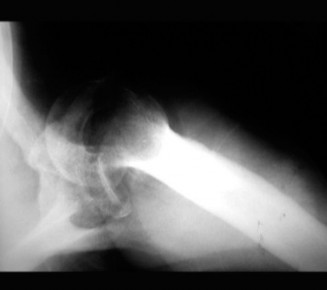 Mastering Shoulder & Elbow cases chronic dislocation: A guide