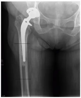 صورة توضيحية لـ مراجعة مفصل الورك: لماذا تتفوق الدعامات الأسطوانية المطلية بالمسام بشكل كامل؟