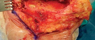 Illustration 27 for Revision of Failed UKA: Your Guide to Successful Treatment