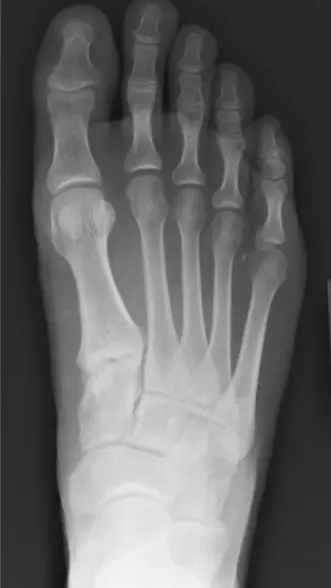 صورة توضيحية لـ آلام القدم الداخلية والخارجية: دليلك الشامل للتشخيص والعلاج مع الأستاذ الدكتور محمد هطيف