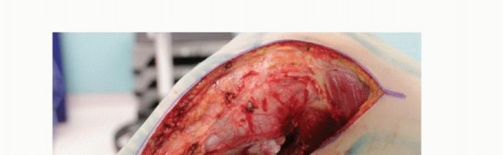 صورة طبية: معالجة الأورام المعقدة في قصبة الساق القريبة حلول الحفاظ على الأطراف