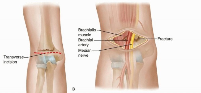 When Supracondylar Fractures Must Be Treated With Open Reduction
