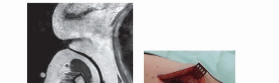 صورة توضيحية لـ الاستئصال الموجه لأورام الجهاز العضلي الهيكلي: نهج أكثر أمانًا وفعالية مع الأستاذ الدكتور محمد هطيف