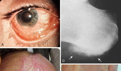 Crystal Deposition Arthropathy: Orthopedic Perspectives, Anatomy, and Biomechanics