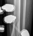 Illustration 5 for Decoding Pilon Fractures: Anterolateral and Medial Fragments Revealed