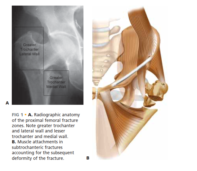 Nailing of the Proximal Femur: Avoid Surgical Complications