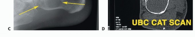 صورة توضيحية لـ أورام القدم: دليلك الشامل للعلاج، البتر، والاستئصال مع الأستاذ الدكتور محمد هطيف في صنعاء