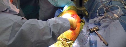 صورة توضيحية لعملية استبدال مفصل الورك