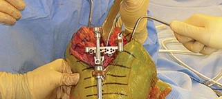 Illustration 18 for Optimize Tibial Component Alignment: Techniques for TKA Success