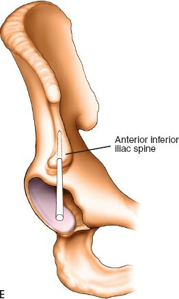 Illustration 28 for Expert Guide: Ulna and Wrist External Fixation Pin Placement