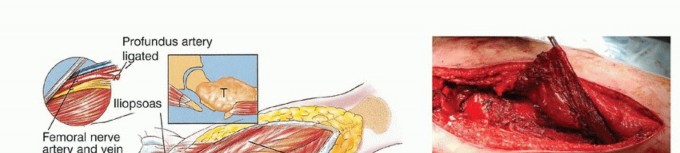 Illustration 21 for Beyond Amputation: Total Femur Resection with Endoprosthetics