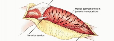 صورة طبية: معالجة الأورام المعقدة في قصبة الساق القريبة حلول الحفاظ على الأطراف