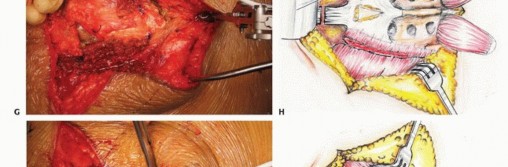 صورة طبية: جراحة أورام العجز: الحفاظ على وظائف الأمعاء والمثانة مع الأستاذ الدكتور محمد هطيف في صنعاء