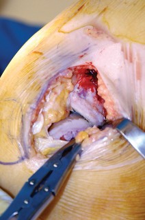 Illustration 23 for Knee Arthroplasty: Avoiding Pitfalls & Benefiting from UKA