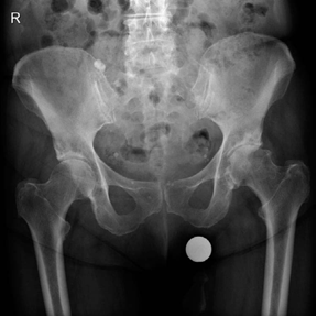 Is Your Femoral Head Affected? Understanding Hip Osteoarthritis