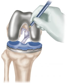 Illustration 8 for Posterior Cruciate Ligament-Retaining TKA: Navigating Pitfalls
