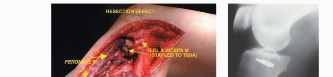 صورة طبية: استئصال أورام الشظية: دليل شامل للعلاج الحديث والحفاظ على الأطراف مع الأستاذ الدكتور محمد هطيف