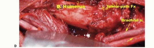 صورة طبية: استئصال الجزء البعيد من عظم العضد: تقنيات آمنة للحفاظ على الطرف في صنعاء مع الأستاذ الدكتور محمد هطيف