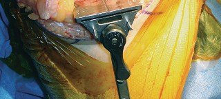 Illustration 53 for Mastering TKA: Essential Methods of Rotational Alignment