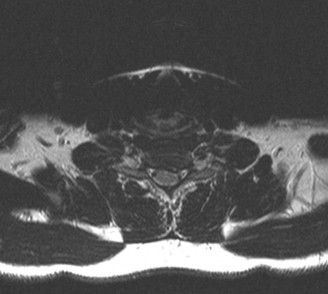 Spondylodiscitis: Deciphering the next course of action