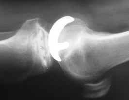 Illustration 78 for Knee Arthroplasty: Avoiding Pitfalls & Benefiting from UKA