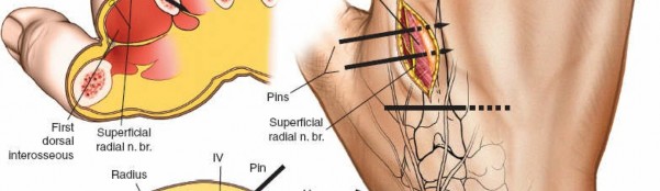 Illustration 10 for Expert Guide: Ulna and Wrist External Fixation Pin Placement
