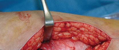 Illustration 18 for Unlock the Figure Posterior Approach to the Hip