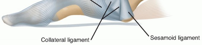 Illustration of arthrodesis of the first - Dr. Mohammed Hutaif