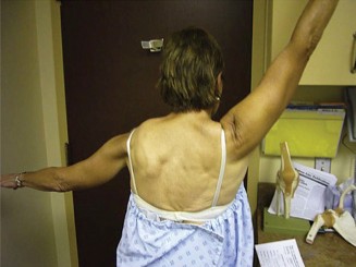 Illustration 2 for Scapular Winging Diagnosis: Is it the Long Thoracic Nerve?