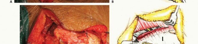 صورة توضيحية لـ جراحة أورام العجز: الحفاظ على وظائف الأمعاء والمثانة مع الأستاذ الدكتور محمد هطيف في صنعاء