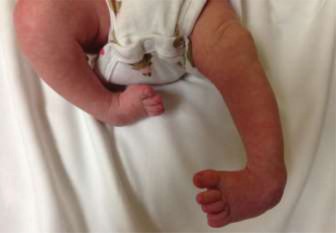 Pediatric Clubfoot: What Your Baby's Anterior Tibialis Tendon Shows