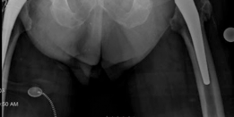 Illustration 2 for Acetabular Revision: Solving Challenges Post Two-Stage Arthroplasty