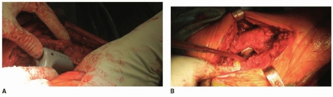 Illustration 7 for Optimizing Revision THA with Tapered Fluted Titanium Stems