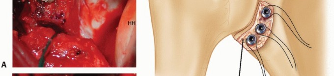 Illustration 24 for Glenoid Bone Graft for Anterior Shoulder Instability: Restore Stability