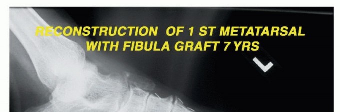 صورة طبية: أورام القدم: دليلك الشامل للعلاج، البتر، والاستئصال مع الأستاذ الدكتور محمد هطيف في صنعاء