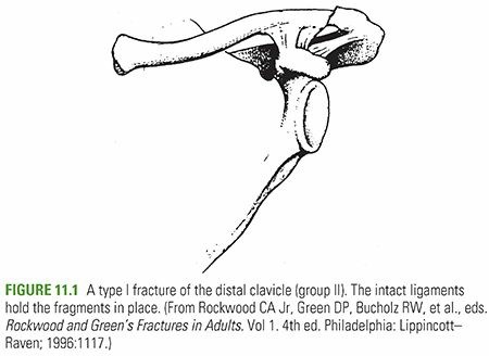 Heal Your Clavicle Fractures: Expert Guide & Recovery Tips